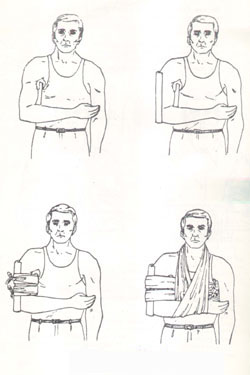 inmovilización de brazo
